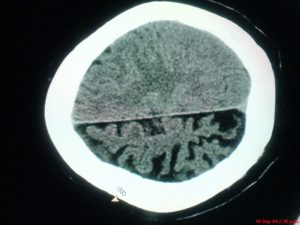 Fig. 1. Atrofia cerebral derecha, pérdida de volumen unilateral, surcos cerebrales prominentes