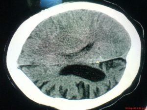 Fig. 2. Dilatación ventricular, hemiatrofia derecha.